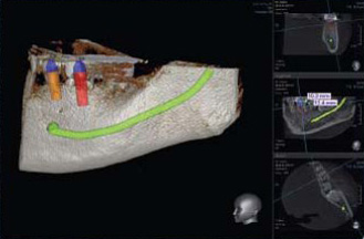 dreidimensionale Implantat Simulation